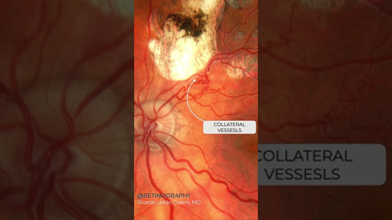 BRVO treated with laser photocoagulation