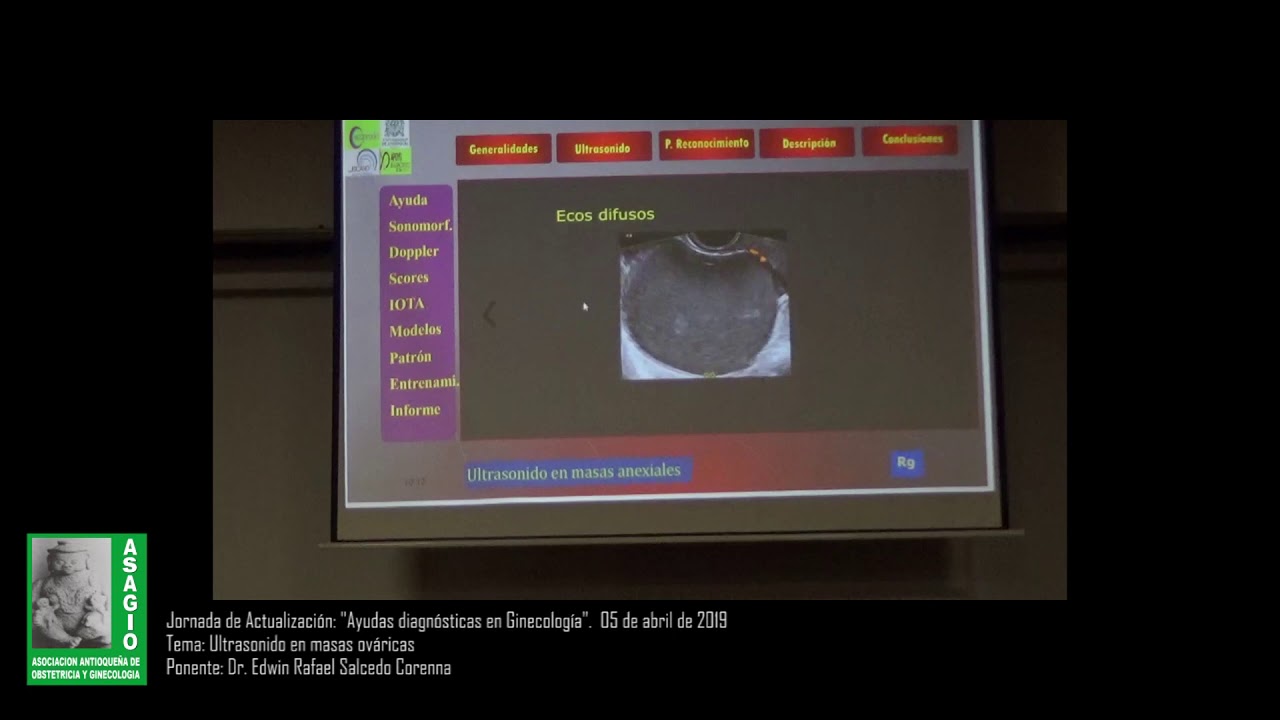 Ultrasonido en masas ováricas. Dr. Edwin Salcedo