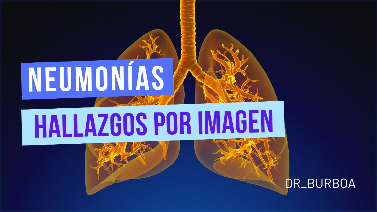 NEUMONÍAS - HALLAZGOS POR IMAGEN