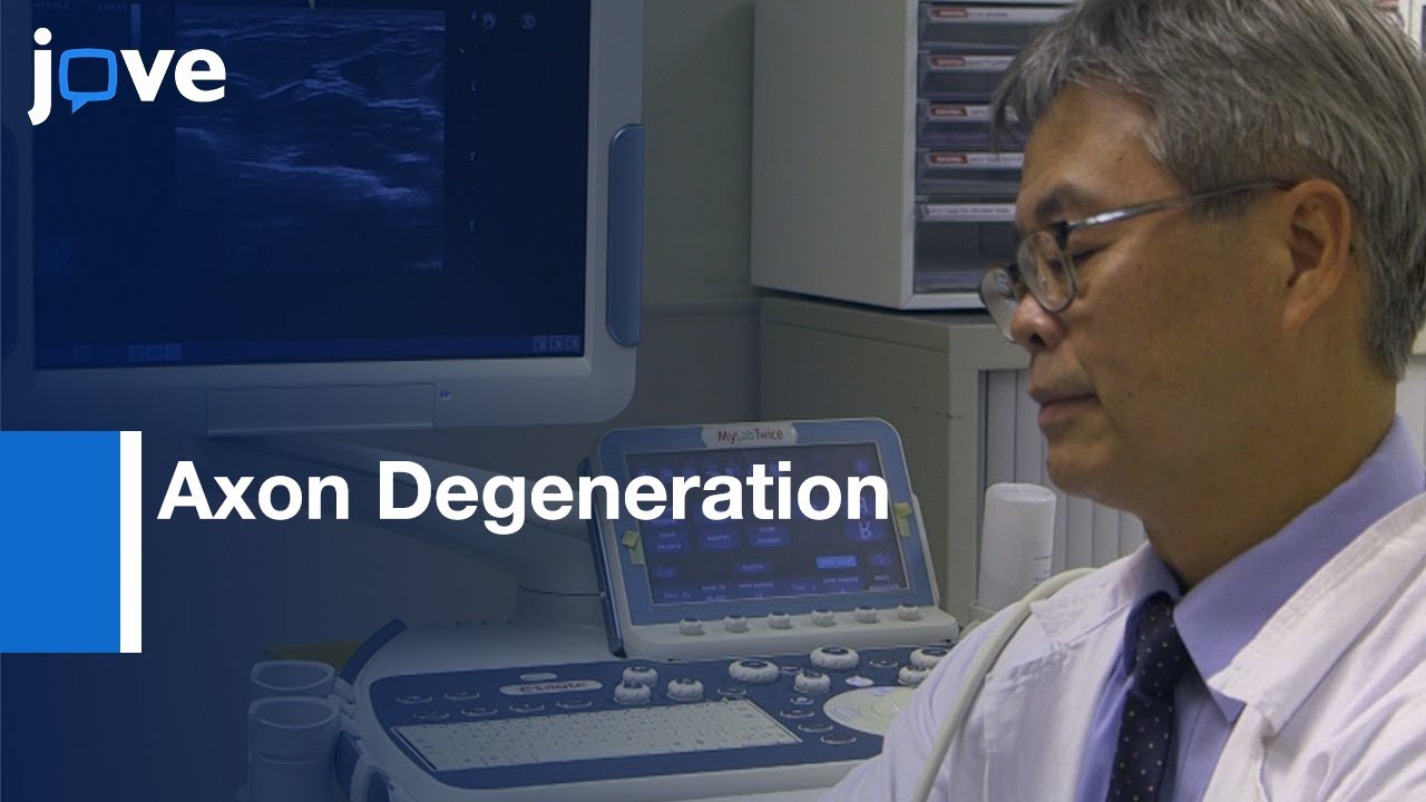 Ultrasonography and Nerve Conduction Study to Screen Axon Degeneration | Protocol Preview