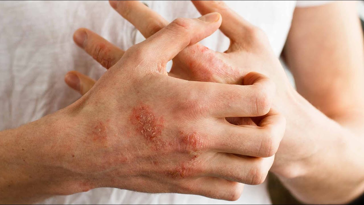 Atopik ekzema xəstəliyi | Dermatoloq Mehdi İSKƏNDƏRLİ