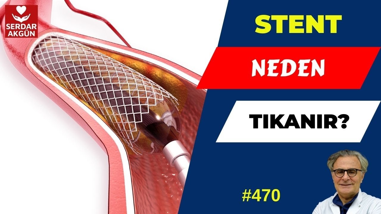 470. Stent Damar Tıkanıklığı,  Stent ile Açmak, Prof.Dr.Serdar akgün, Serdar akgün , Tıp Videoları