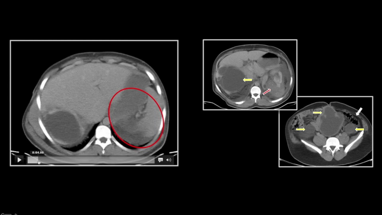 Renal Trauma | Interesting Radiology Cases
