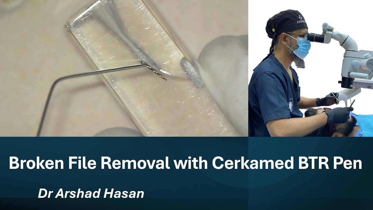Broken File Removal With Cerkamed BTR Pen