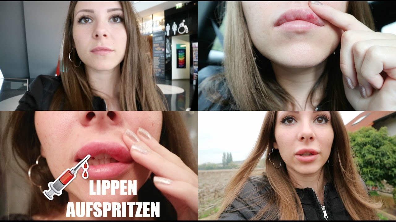 LIPPEN AUFSPRITZEN 💉  - STÜNDLICHE UPDATES - SCHWELLUNG | SCHMERZEN | KOSTEN