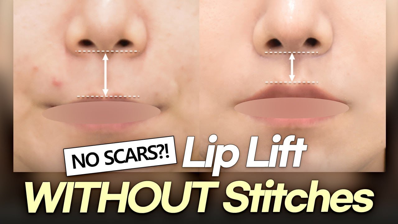 No-Scar Philtrum Reduction Surgery | Sutureless Lip Lift for a Youthful Look