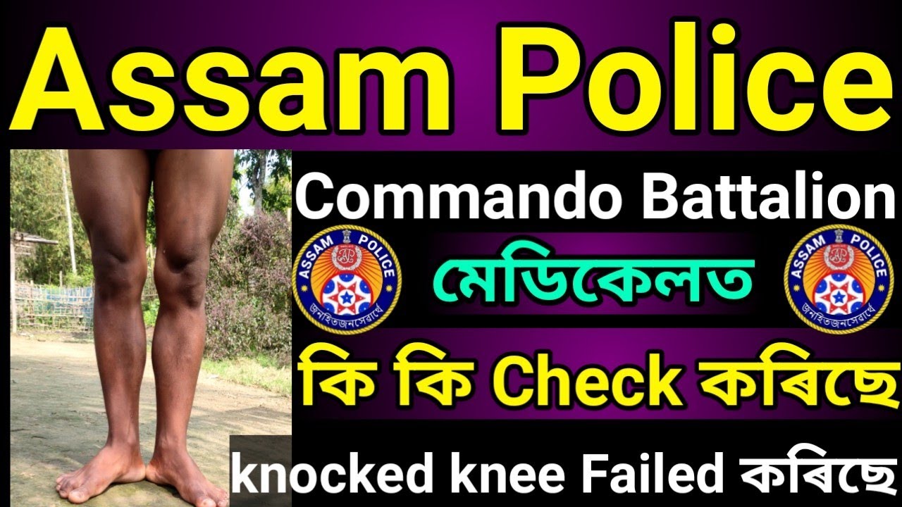 Assam Police Commando Battalion Medical Test কি কি চাইছে knocked knee failed কৰিছে Full Details