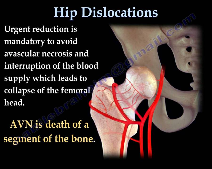 Hip Dislocations - Everything You Need To Know - Dr. Nabil Ebraheim