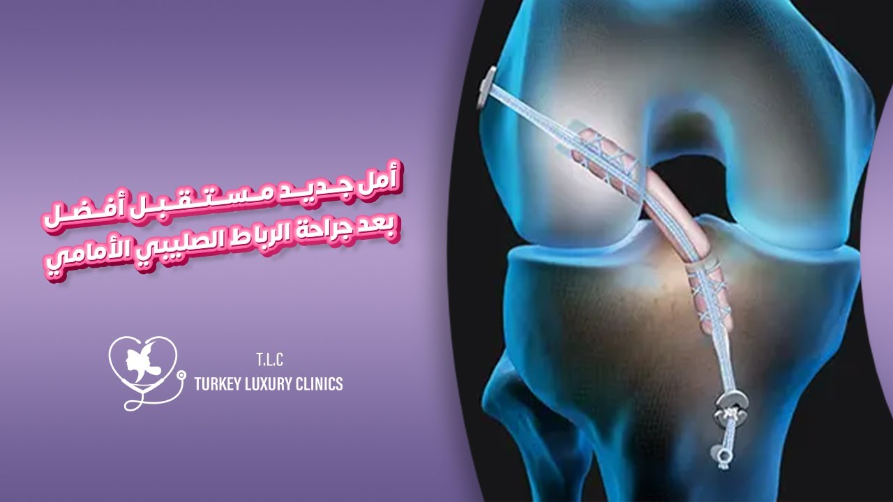 جراحة إعادة بناء الرباط الصليبي الأمامي: التقنية والفوائد الشاملة