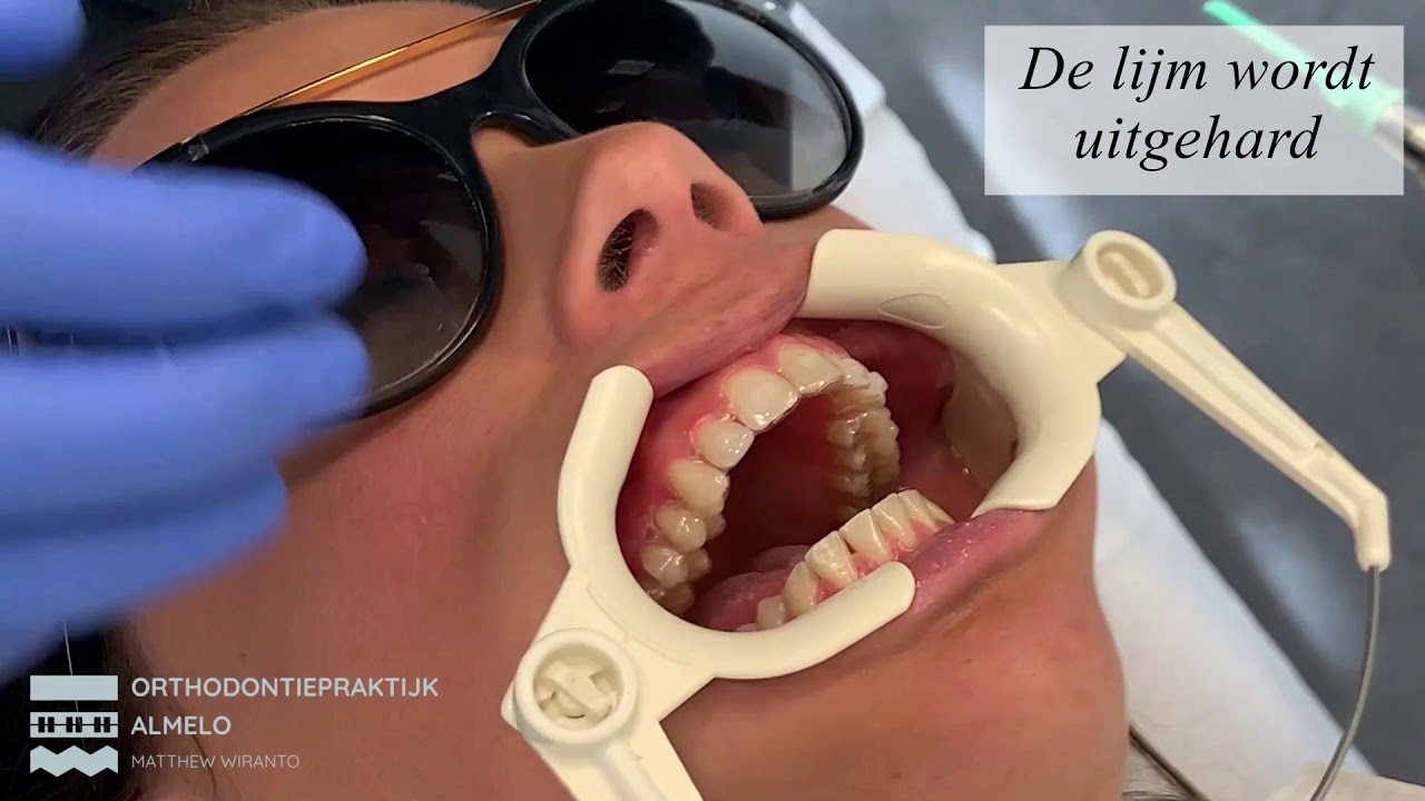 Plaatsen Invisalign beugel Orthodontiepraktijk Almelo