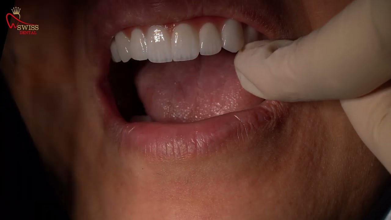 استلام تركيبات الفك الكامل 😊💯 | ?Dental Implant | How it looks