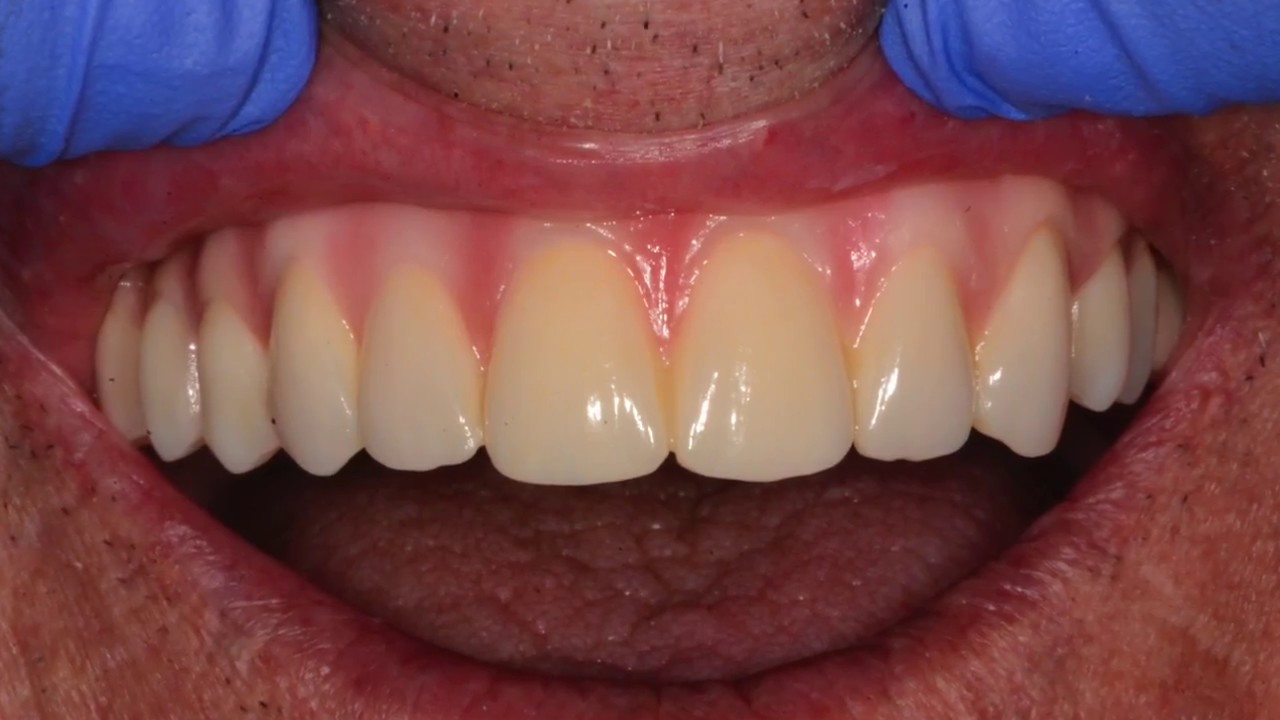Same Day Dentures