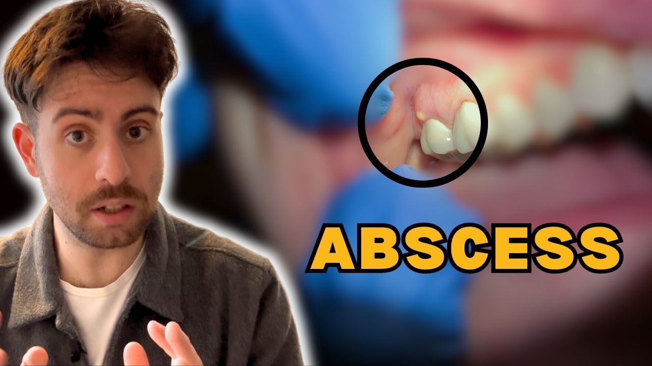Tooth Abscess Symptoms & Treatment Explained