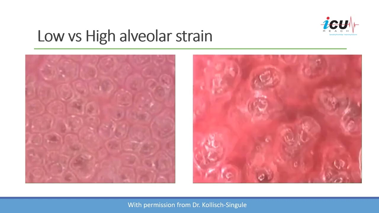 Understanding the Concept of Stress and Strain in ARDS