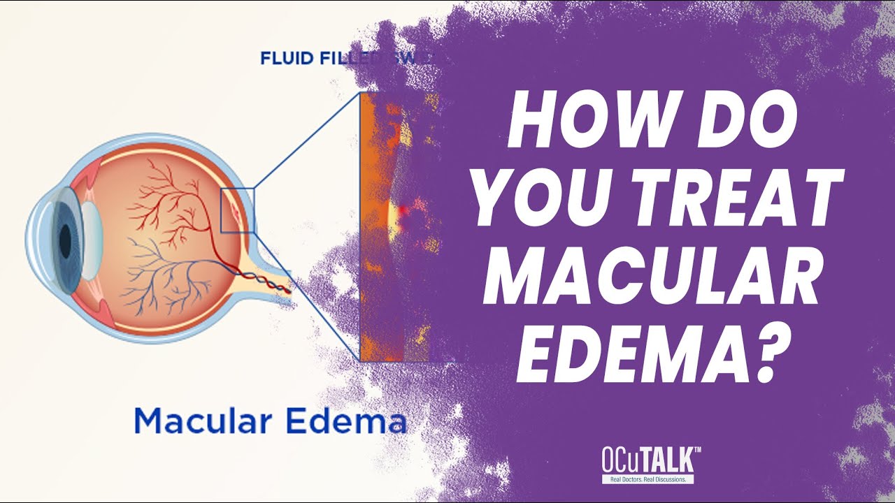How do you Treat Macular Edema? - Dr. Lazar explains
