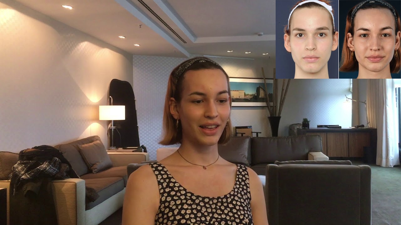 Facial Feminization Surgery Review - Franka, Dr Bart van de Ven reviews