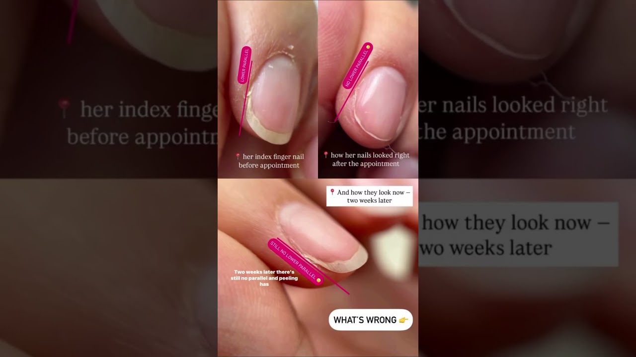 Has this ever happened to you? #nailtutorial #shortnails #nailcare #nailfile #onycholysis