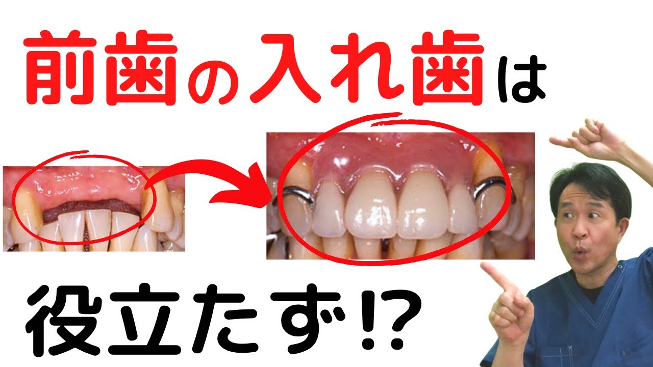 【前歯の入れ歯】外れやすくて、全く噛めないって言うのは本当⁉︎ 歯医者が解説