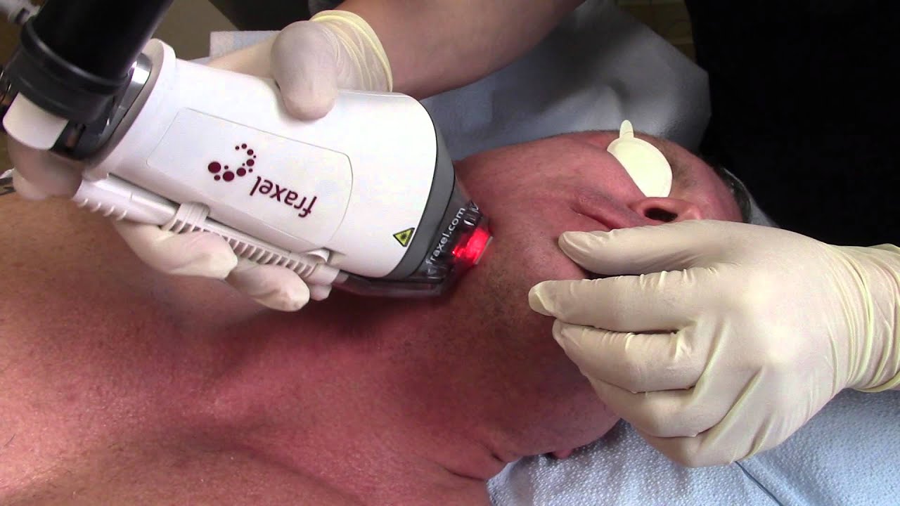 Fraxel DUAL Non-Ablative Laser For Neck Wrinkles, Sun Spots, Sun Damage (Age Prevention In a Male)