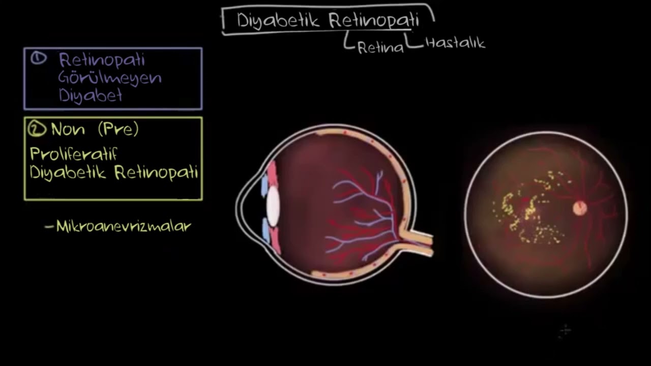 Diyabetik Retinopati (Sağlık Bilgisi ve Tıp)