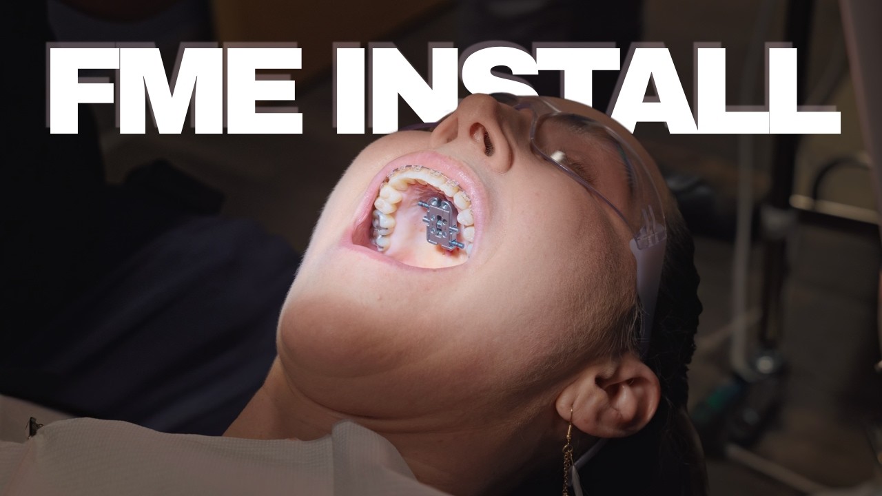 FME Surgery Unveiled: The Complete Installation Process with Dr. Newaz