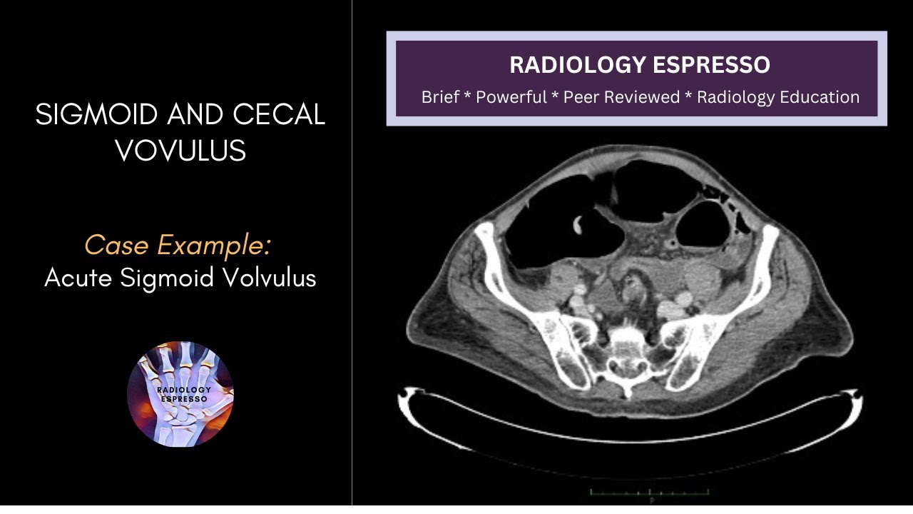 SIGMOID AND CECAL VOLVULUS: Case Example - Acute Sigmoid Volvulus on CT (4530)