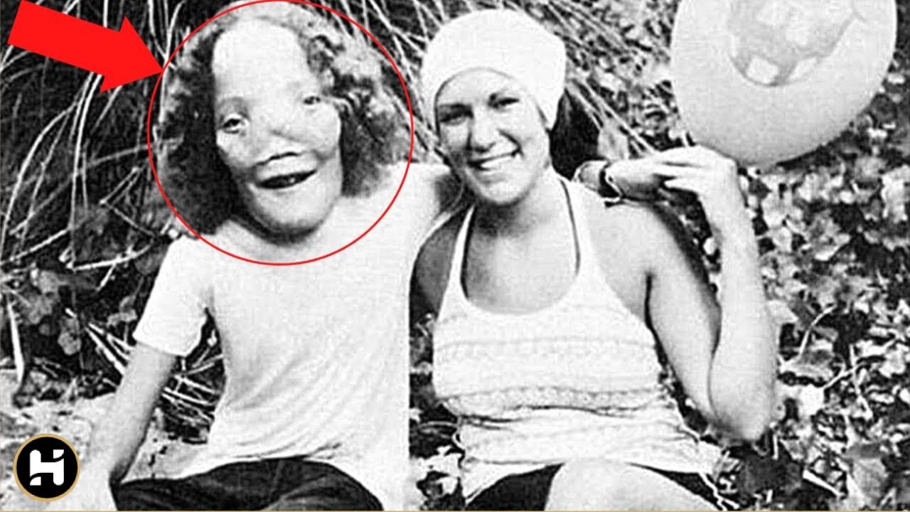 Ele nasceu com uma condição rara e sua vida virou filme - A Extraordinária história de Rocky Dennis