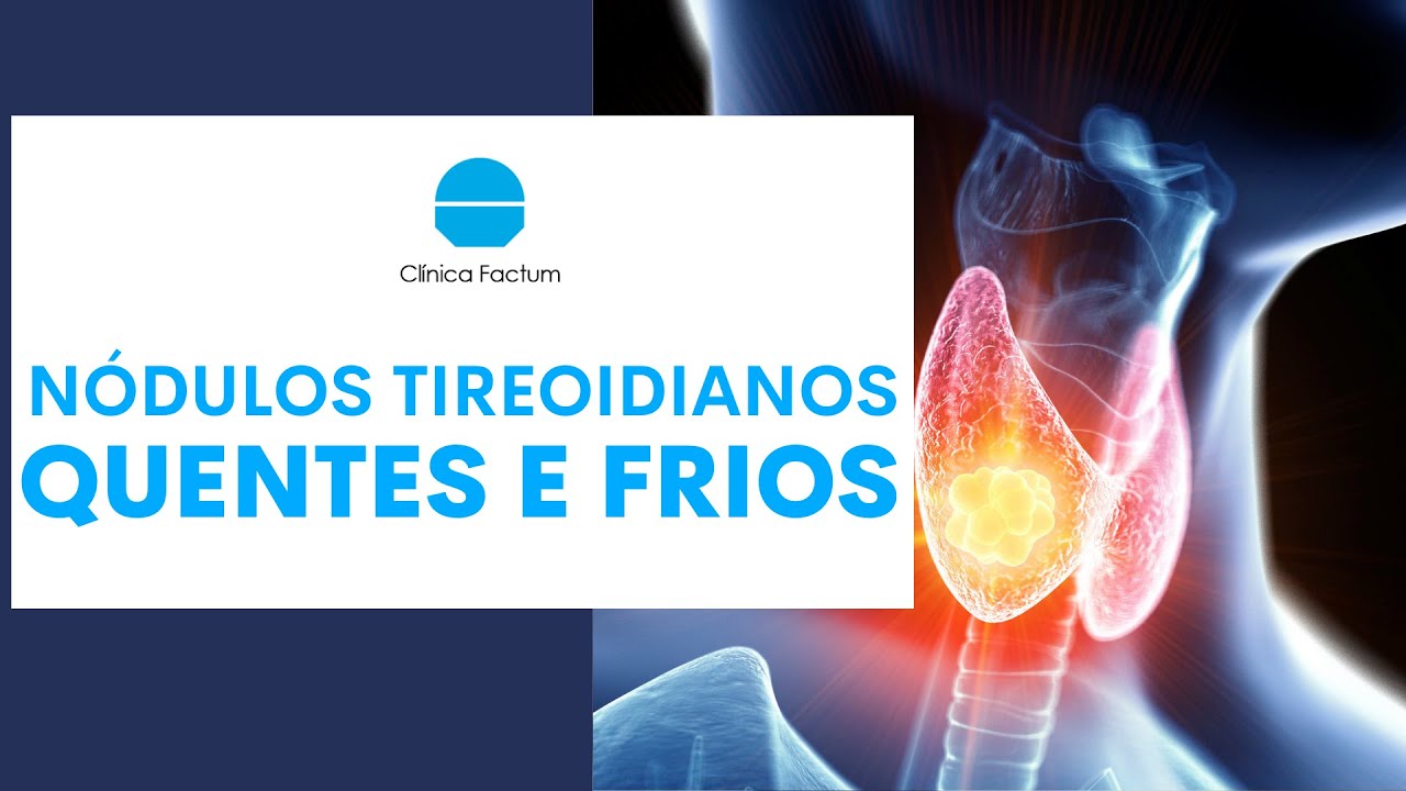 NÓDULOS TIREOIDIANOS QUENTES e FRIOS