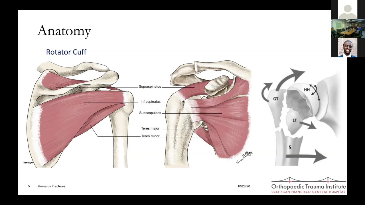 Proximal Humerus Fractures - Dr. Ding