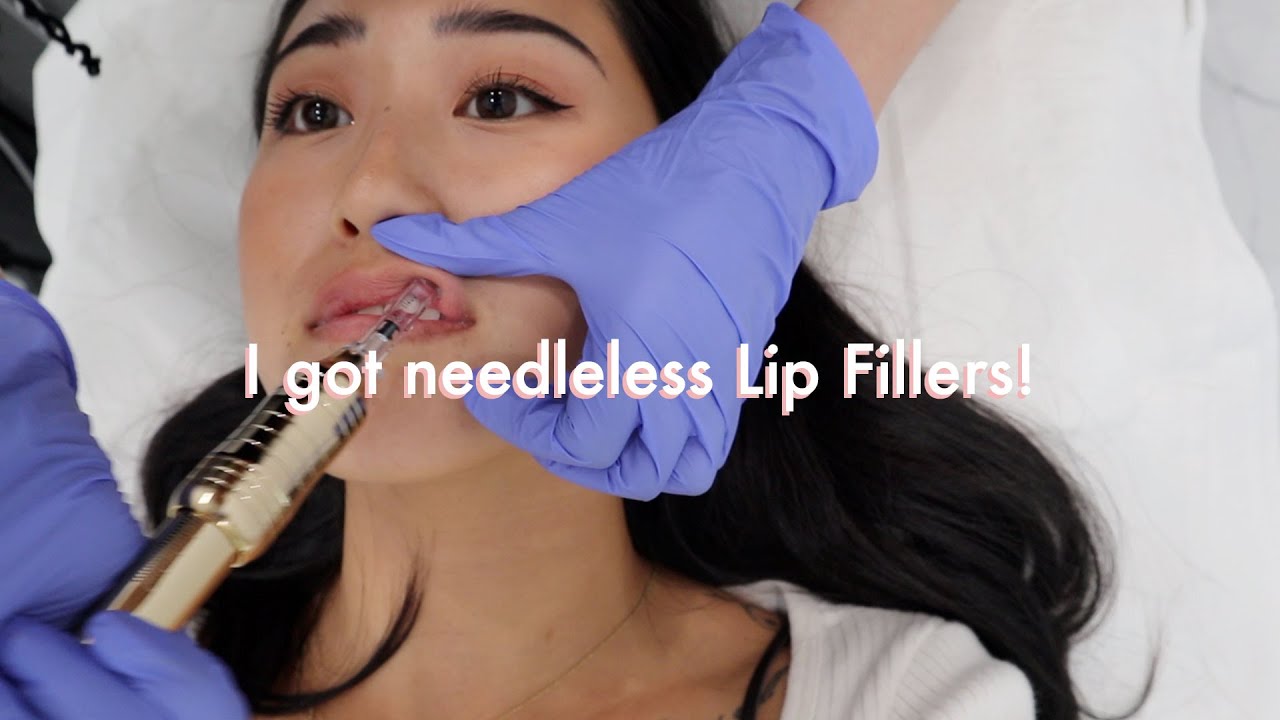 I Got Needleless Lip Fillers (Hyaluron Pen) + Hanging With Friends