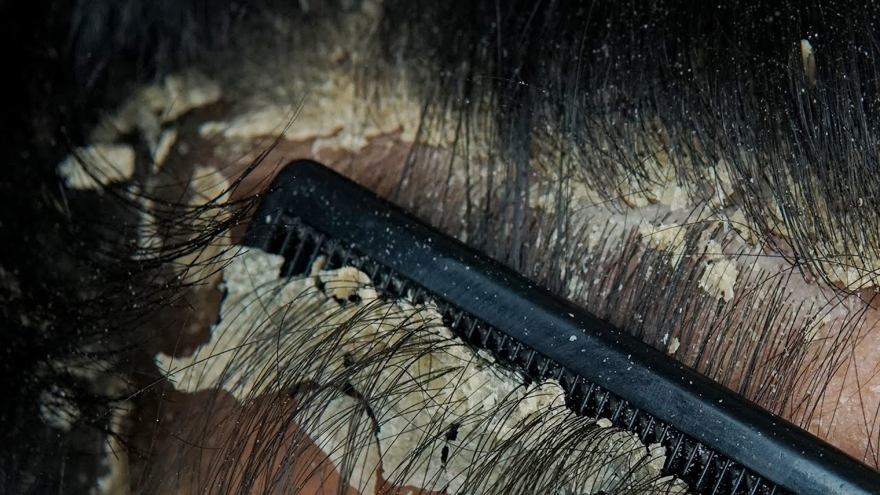 ASMR Satisfying Dandruff Treatment & Scalp Check #27