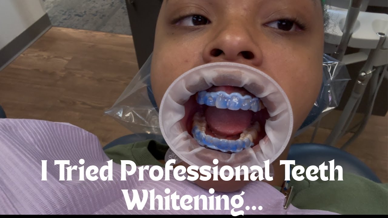 I Tried Professional Teeth Whitening ✨