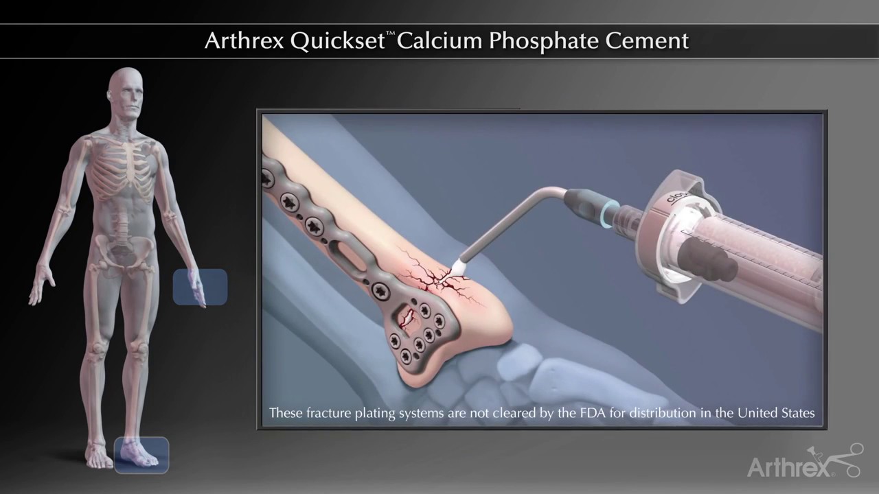 Arthrex Quickset™ Calcium Phosphate Cement