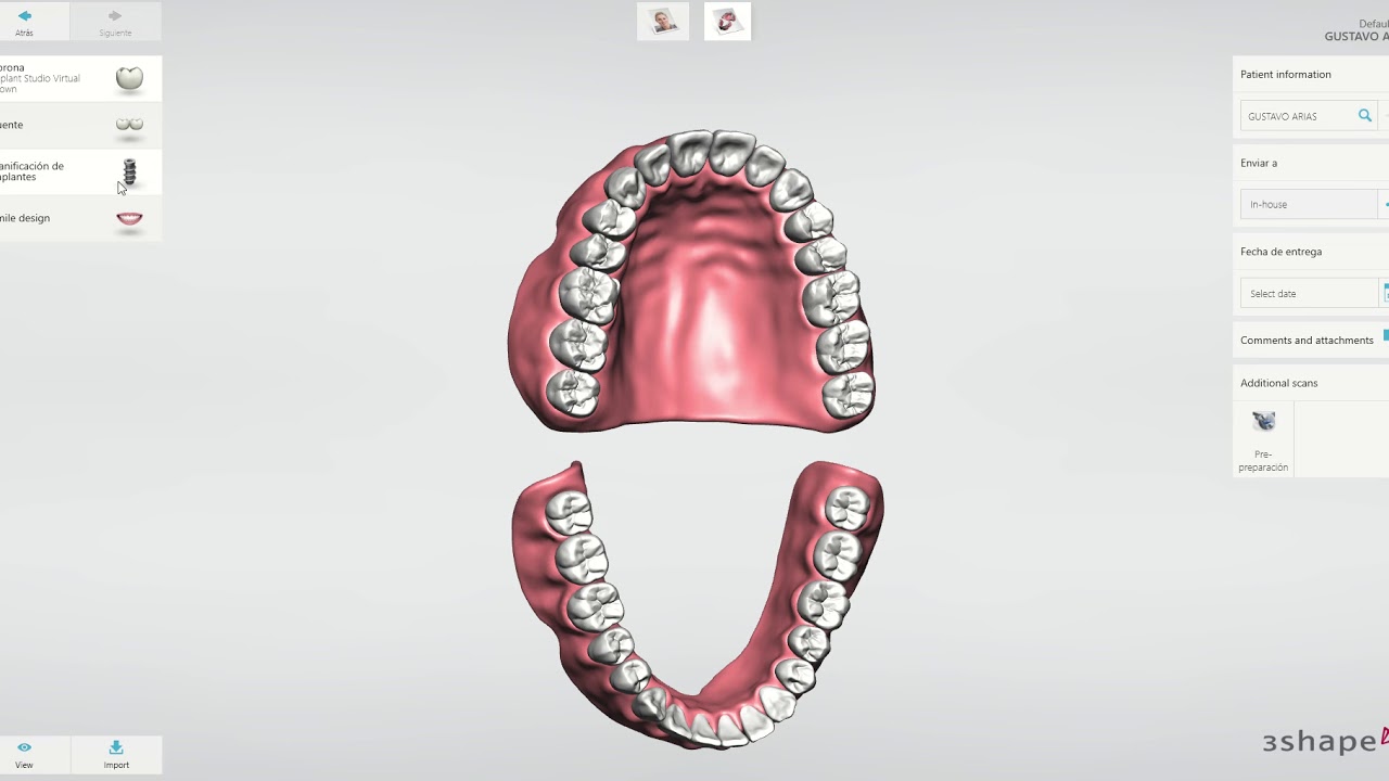 Guía quirúrgica realizada con 3shape Implant Studio