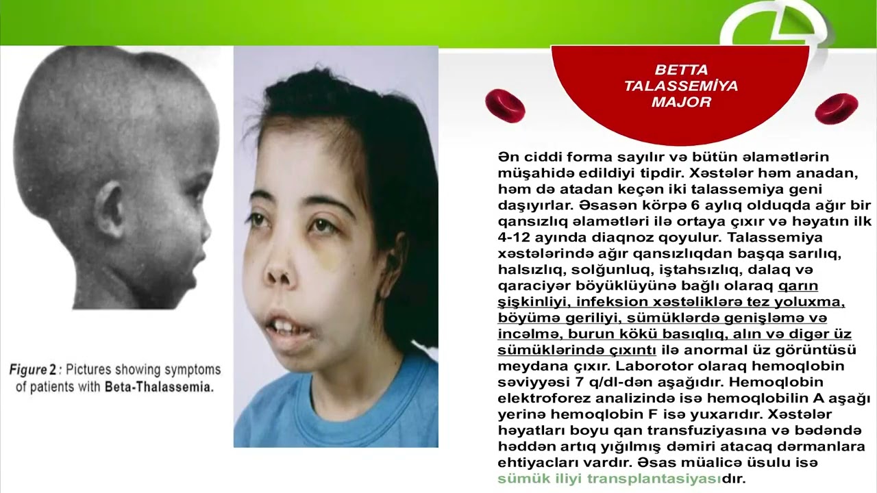 Video Dərs Mövzu:Talassemiya xəstəliyi