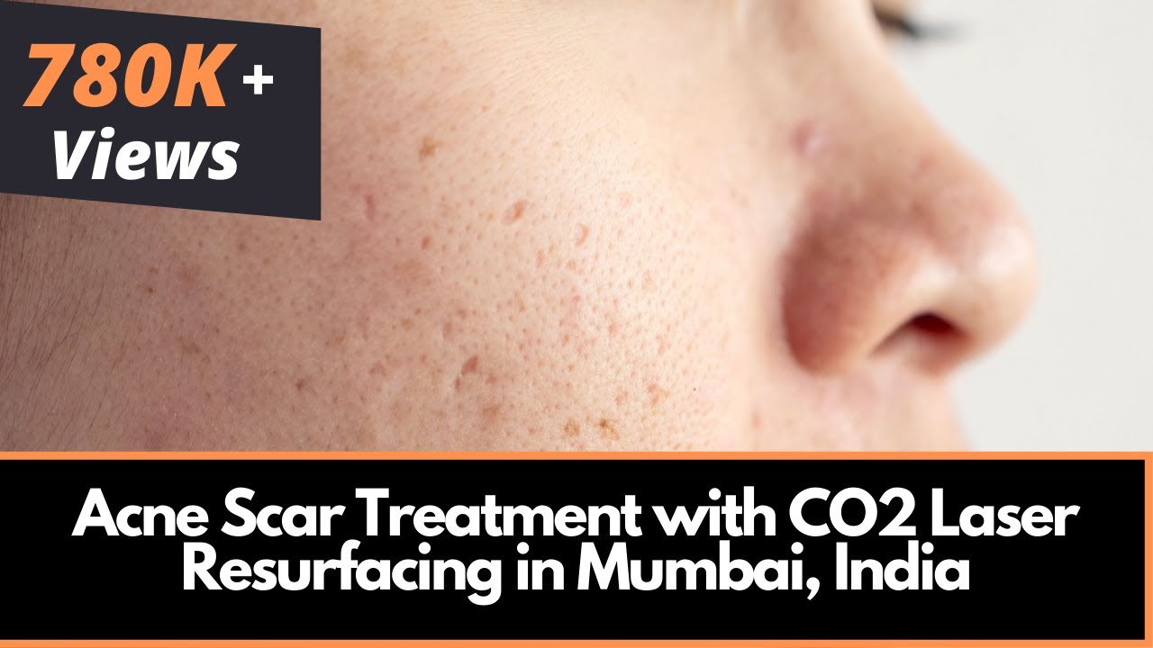 Acne Scar Treatment with CO2 Laser Resurfacing in Mumbai, India | Dr. Rinky Kapoor