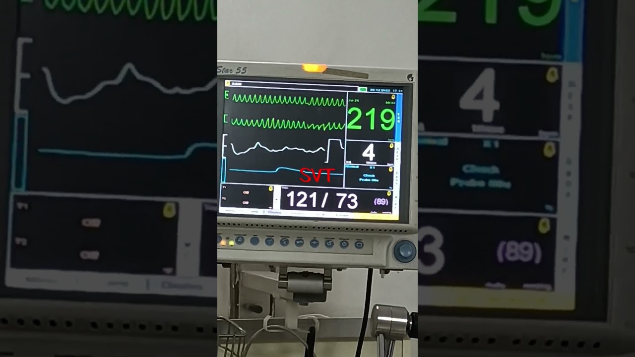 ventricular tachycardia in cardiac monitor