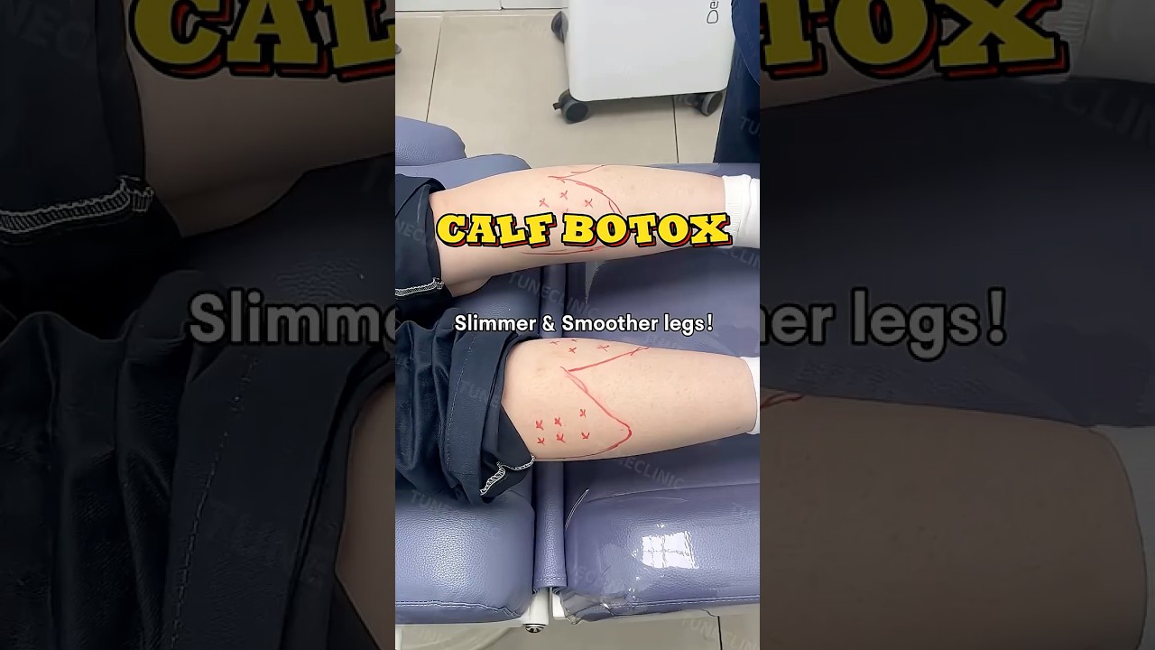 Stop Hiding Your Legs! How I Slimmed My Calves with Botox  #skinclinic #botox #calves #muscles