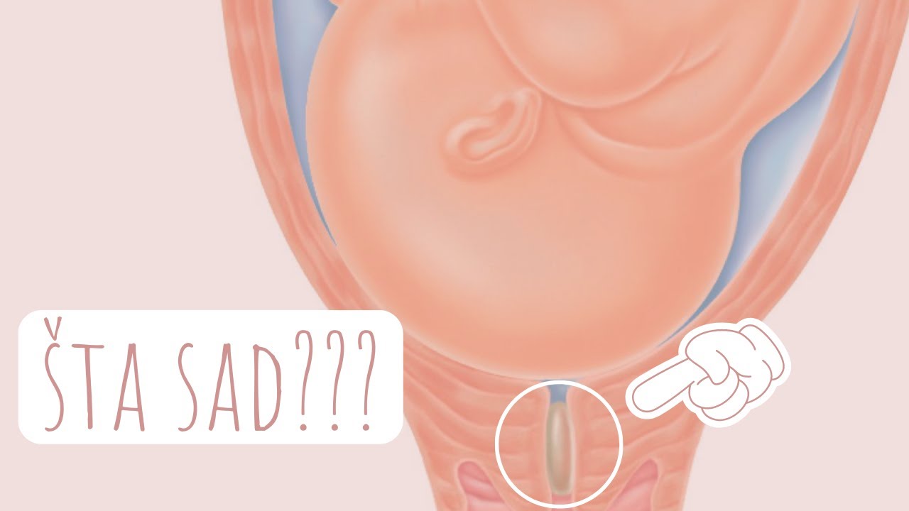 Ispao ti je sluzni čep?