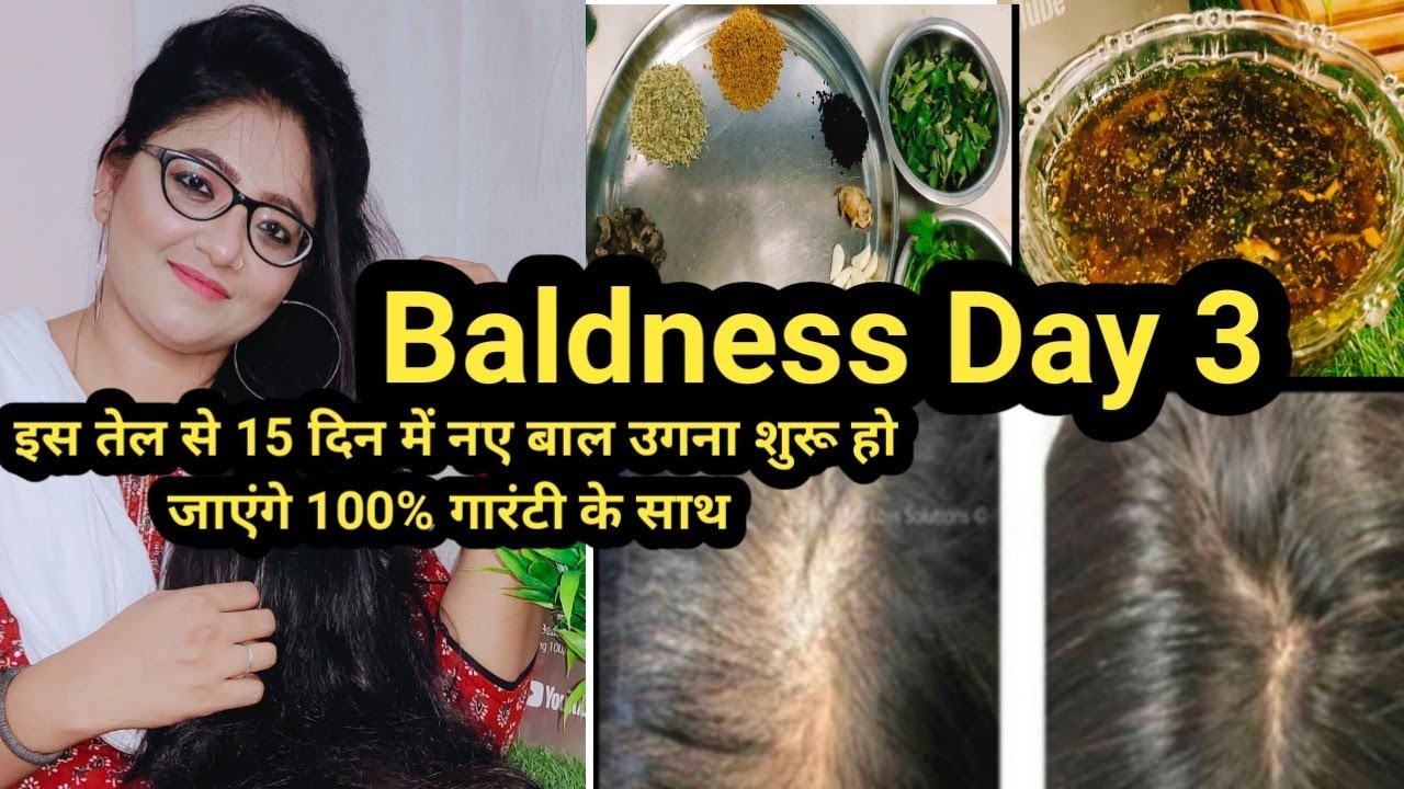 यह तेल गंजेपन को दूर करेगा और सर में बाल ही बाल उगा देगा अब Baldness से छुटकारा पाएं हमेशा के लिए