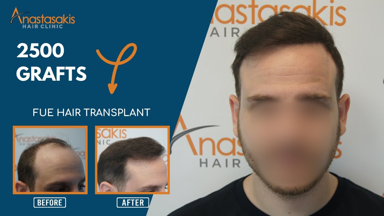 Μεταμόσχευση Μαλλιών Anastasakis Hair Clinic: 2 Χρόνια Μετά - FUE 5000 Τριχοθυλάκια! 💪🔥 Case #255