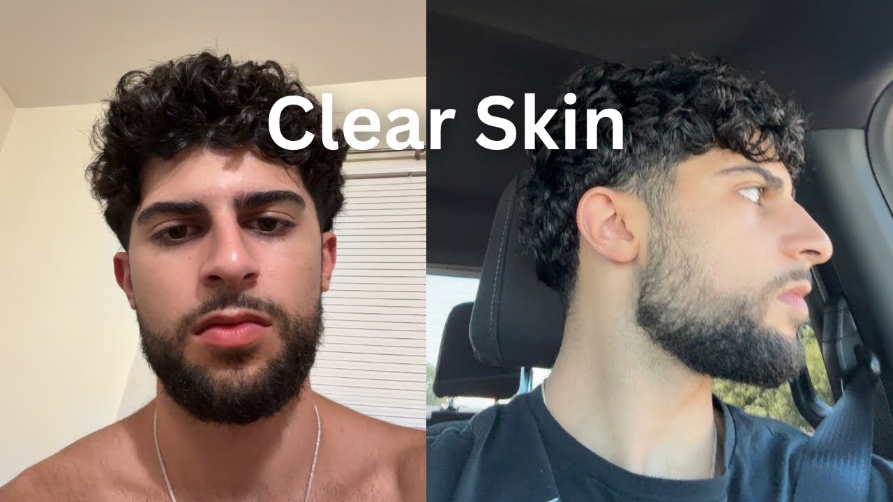 How To Get Clear Skin (Fast)