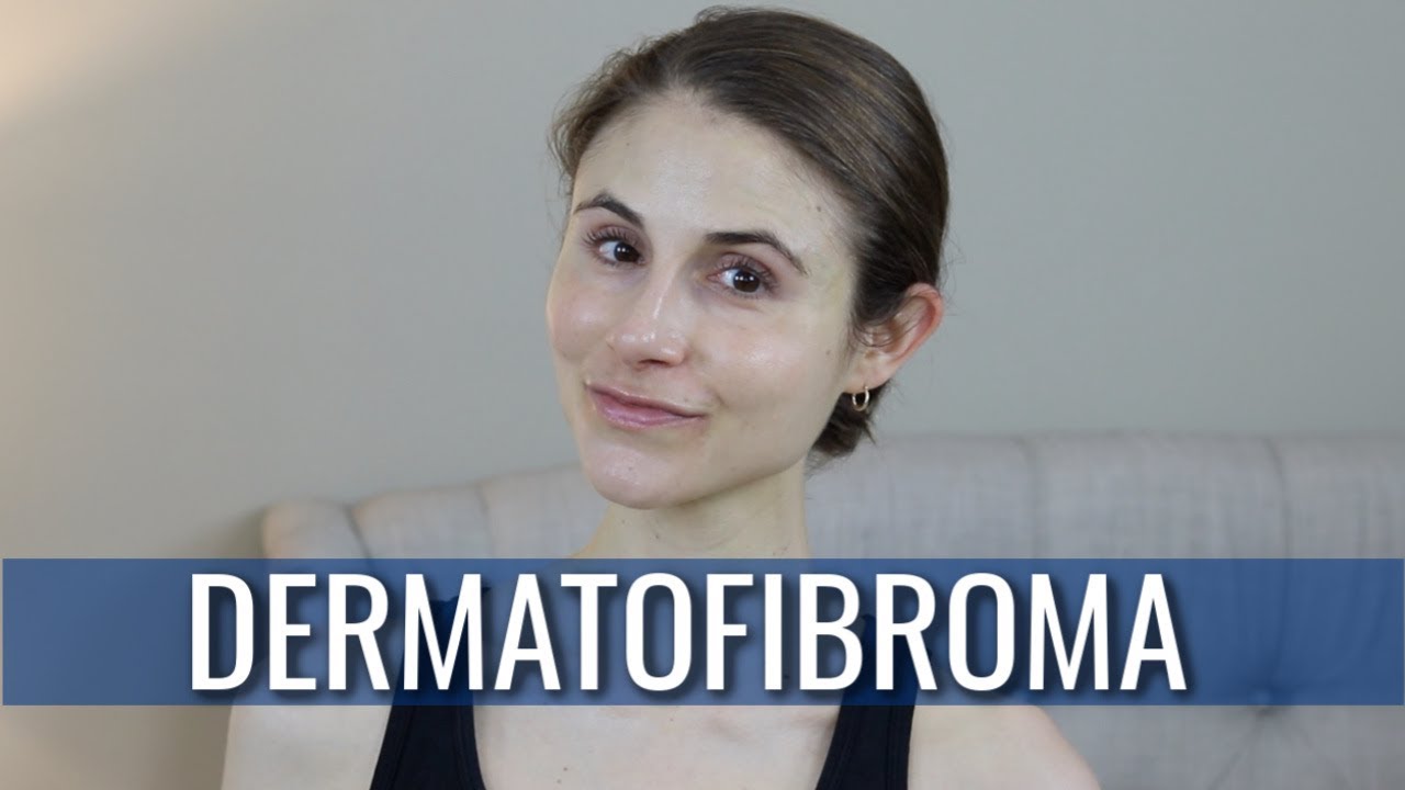 DERMATOFIBROMA: WHAT IS IT? HOW IS IT TREATED? | DR DRAY