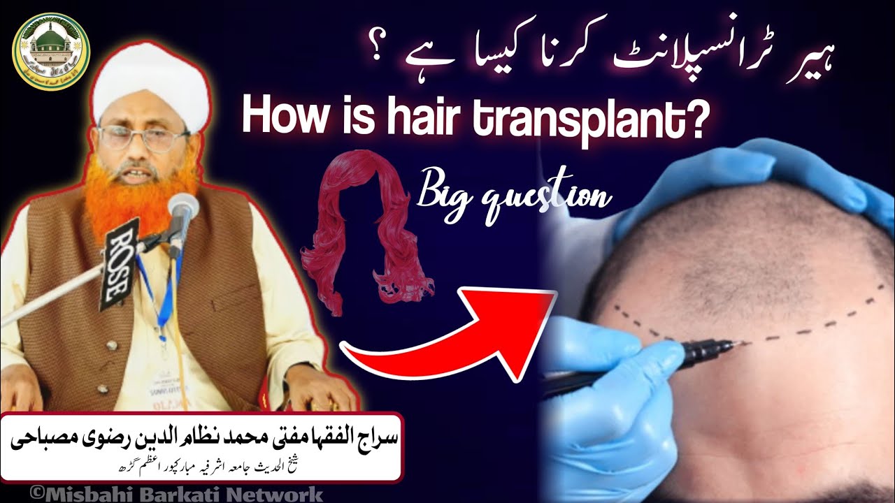 How is Hair Transplant ?🛡️✅🙇 Hair Transplant Karna Kaisa Hai | Serajul Foqha Mufti Nezamuddin Razvi