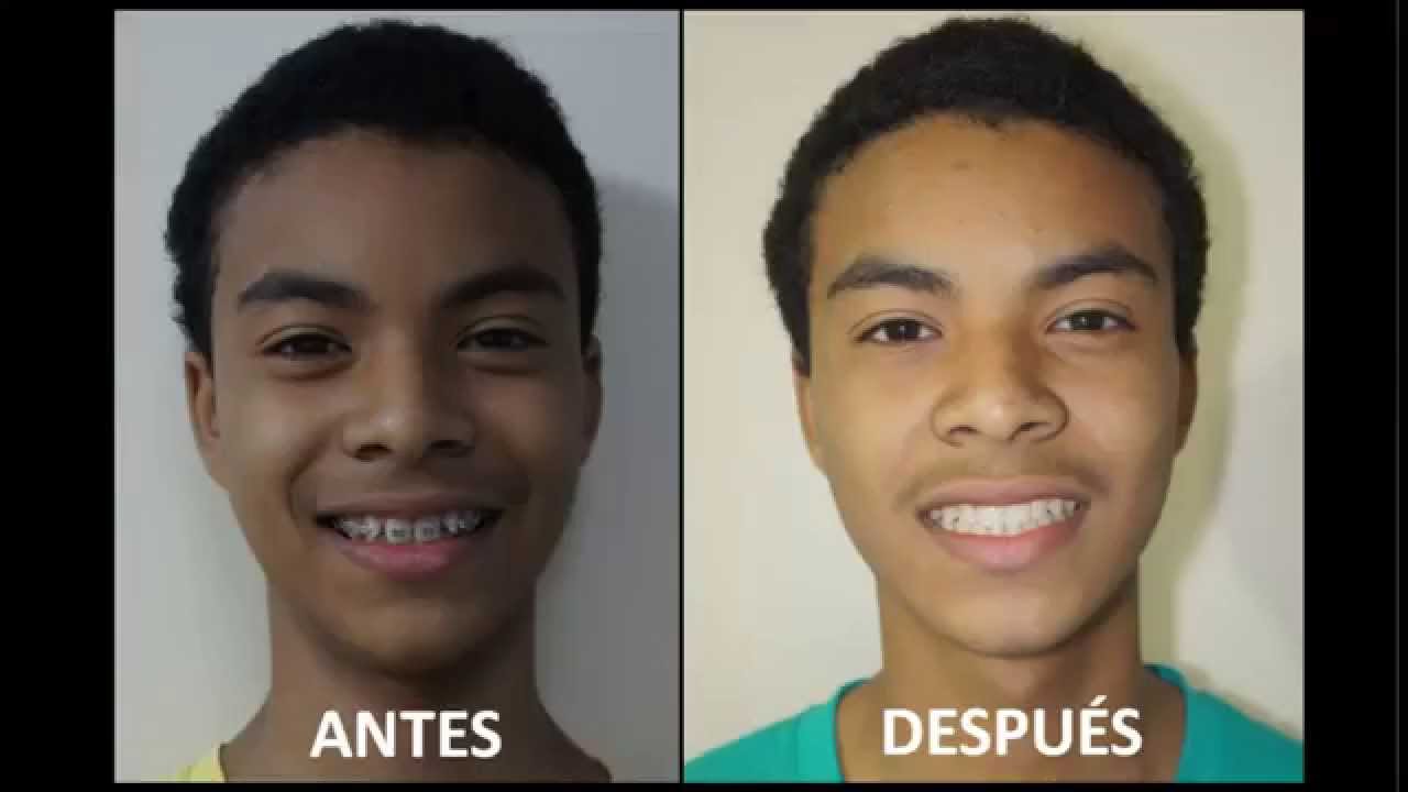 ORTODONCIA ANTES Y DESPUÉS.PACIENTE CON DIASTEMA. By DR. JAVIER TOMALÁ ROSALES