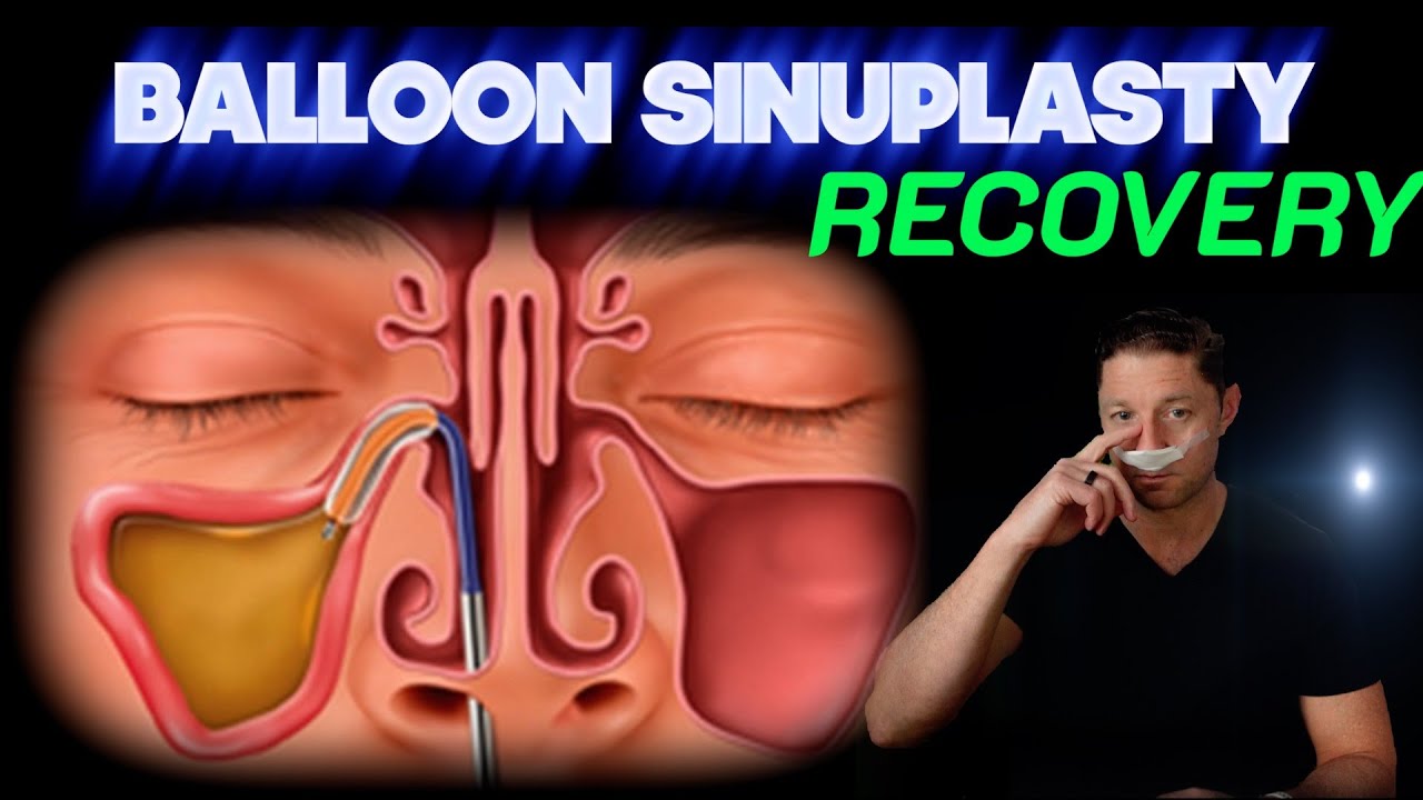 How Long Does It Take To Recover From Balloon Sinuplasty Surgery