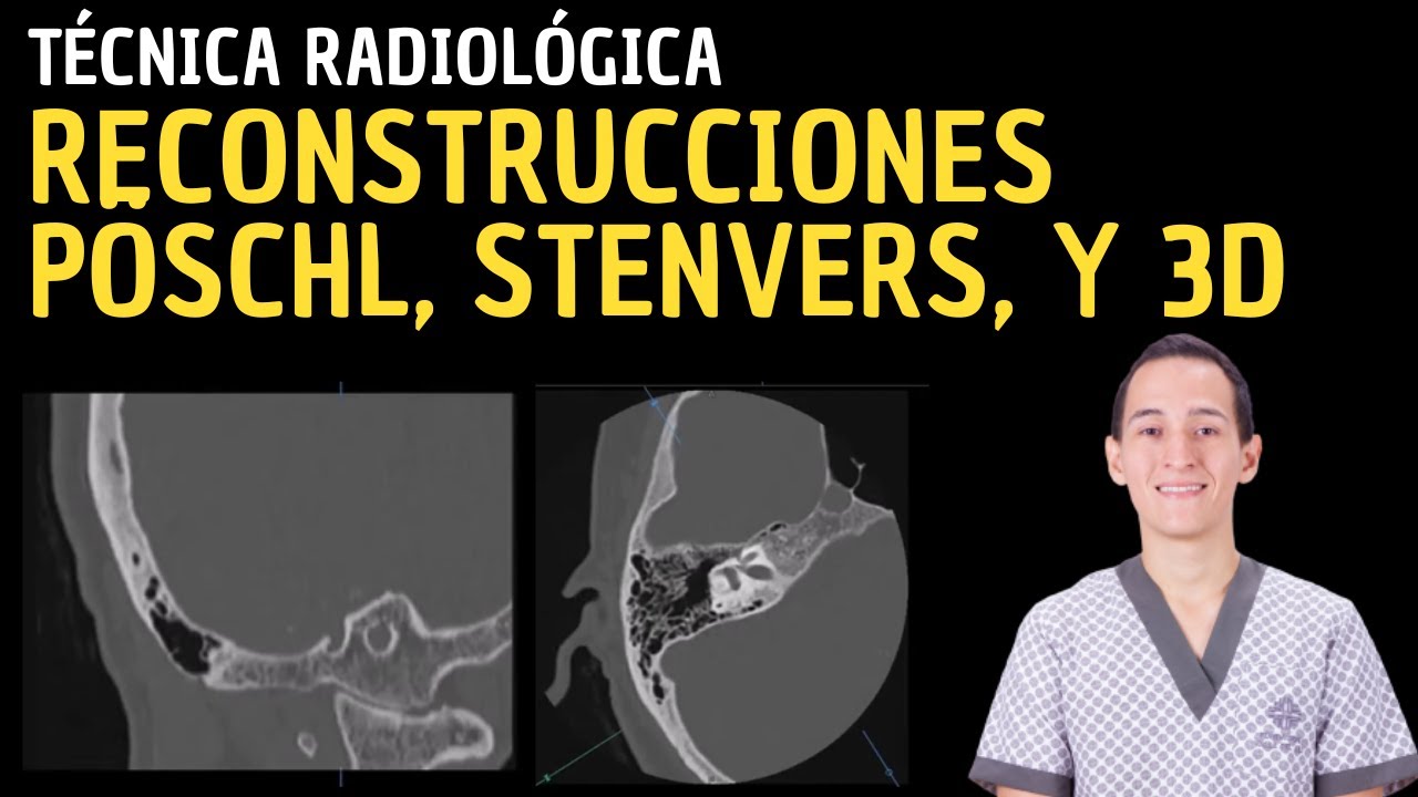 Tutorial Tomografía Computarizada Oído: Reconstrucciones Pöschl, Stenvers, y 3D.