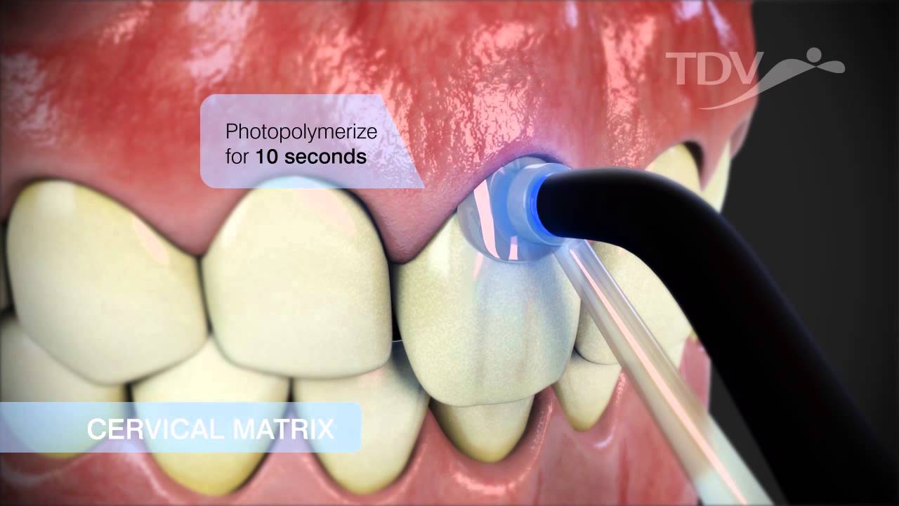 CERVICAL MATRIX TDV - Class V Restorations
