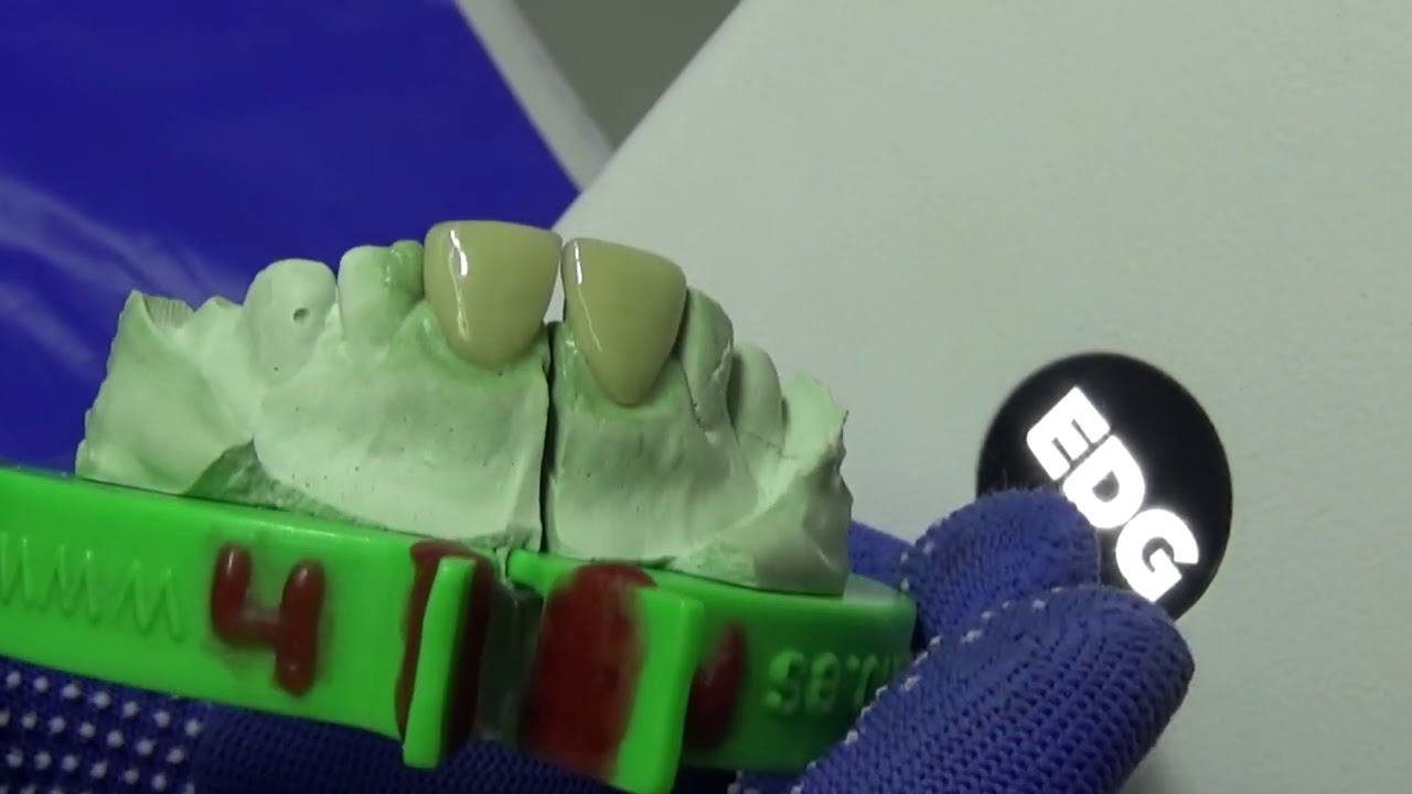 COMO SE HACEN LAS CARIILAS EN CEROMERO DENTAL