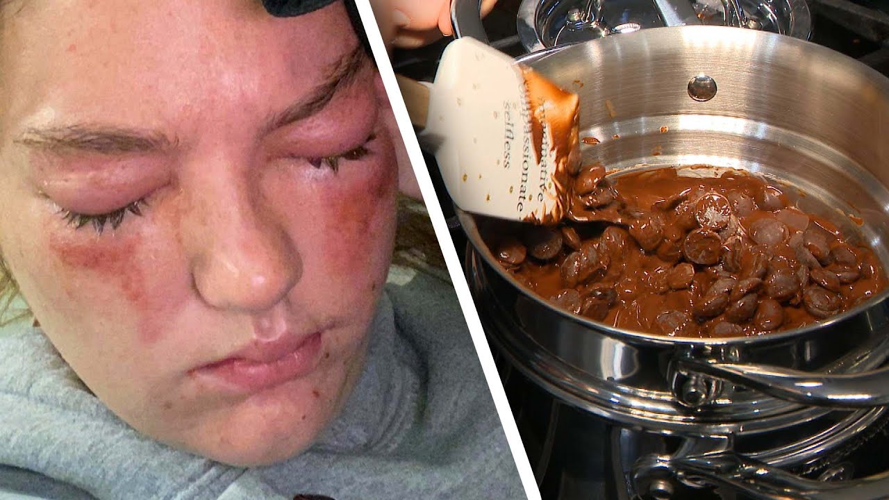 Exploding Chocolate Nearly Blinds 19-Year-Old Student